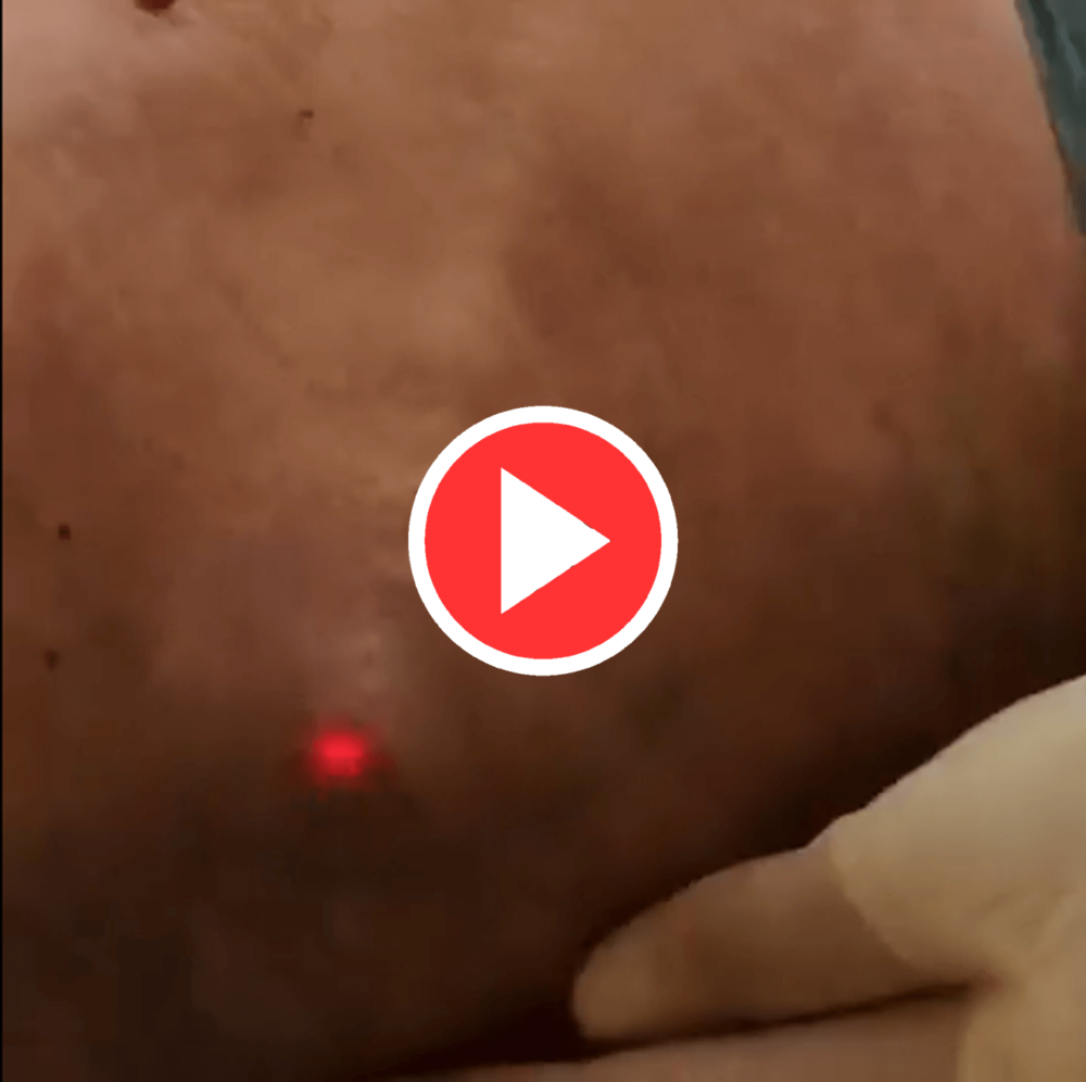 Argon Plasma Skin Tightening video 2.1