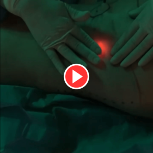 Argon Plasma Skin Tightening video 3.1